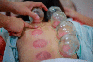 Cupping therapy being applied to a client's back to stimulate the nervous system and release deep fascial tension.